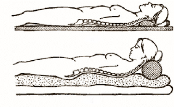 Osteokondroosi joonis